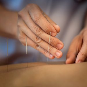 Acupuncture Close Up